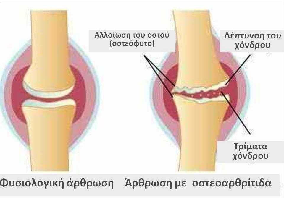 tipi di artrite